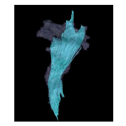 White Matter Fibers (Turkish)